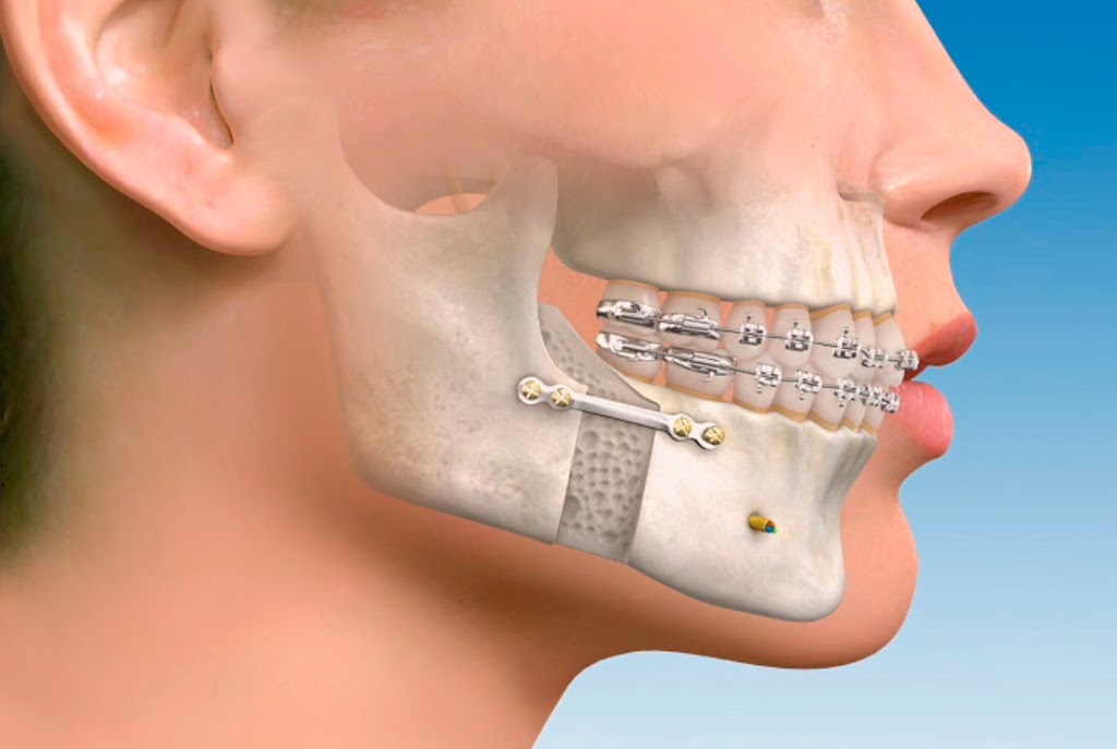 ¿Cuándo es necesaria la cirugía maxilofacial?