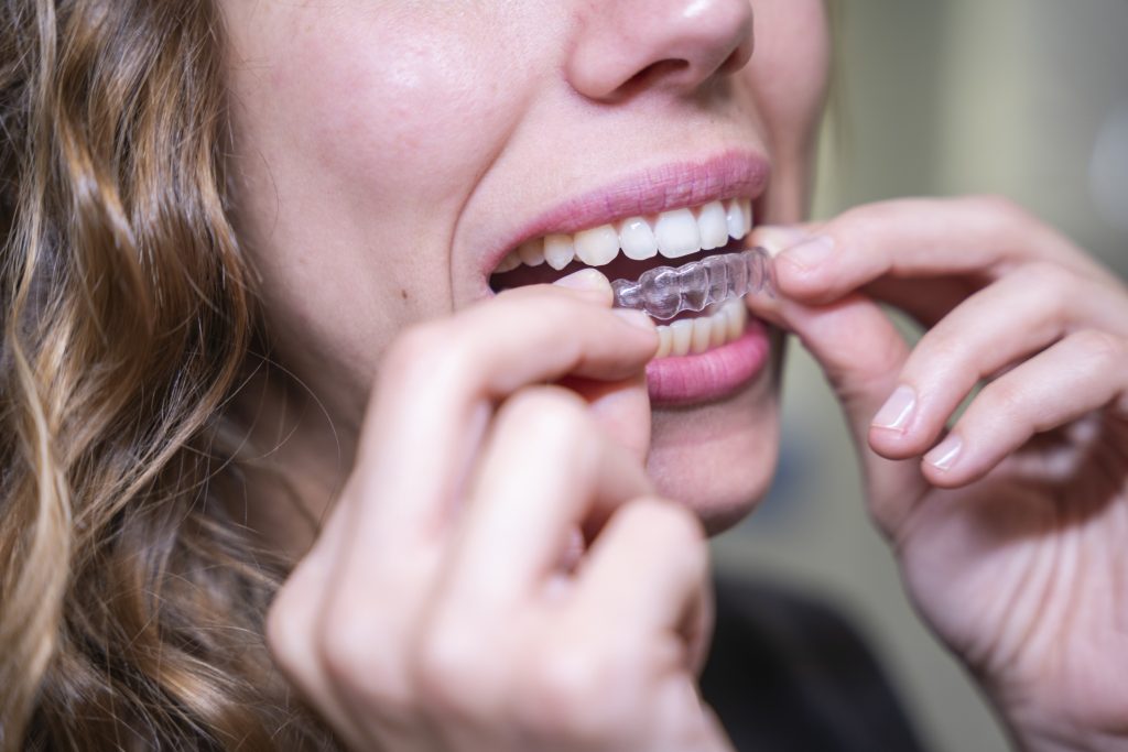 ¿Qué son los ataches en ortodoncia invisible?