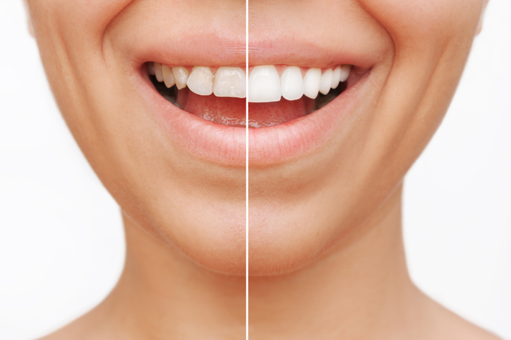 Transforma tu sonrisa con carillas dentales