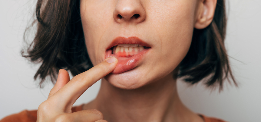 ¿Qué es la periodontitis?
