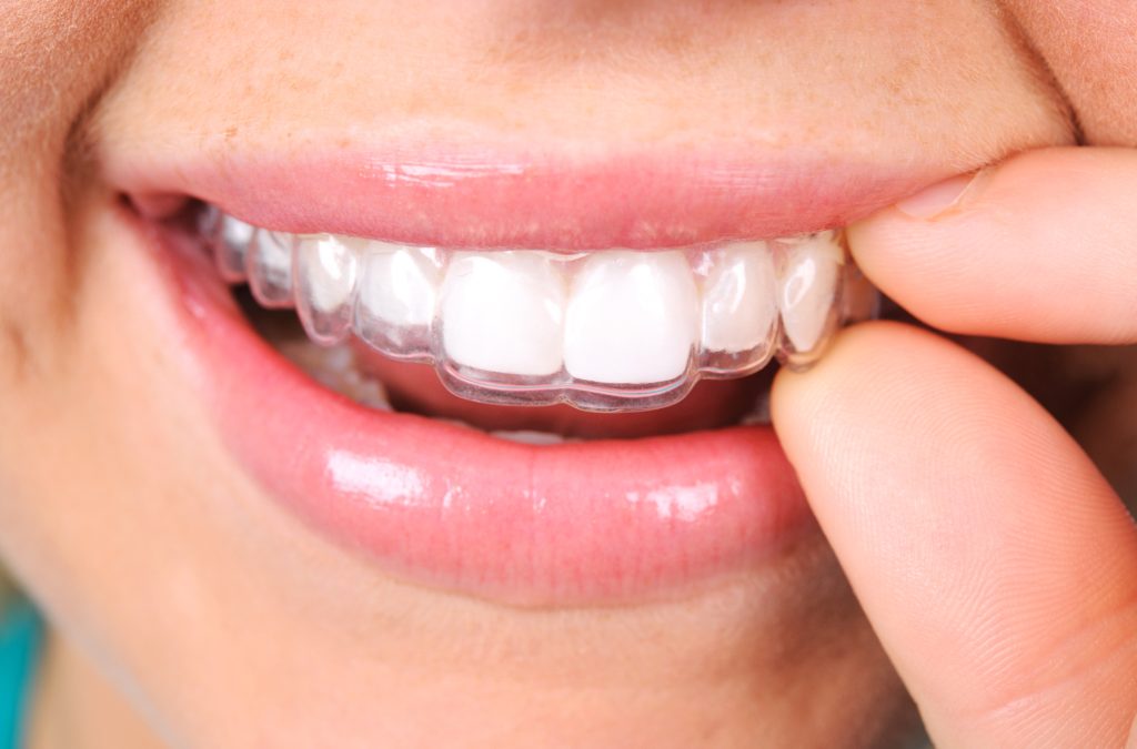 ¿Brackets u ortodoncia invisible?