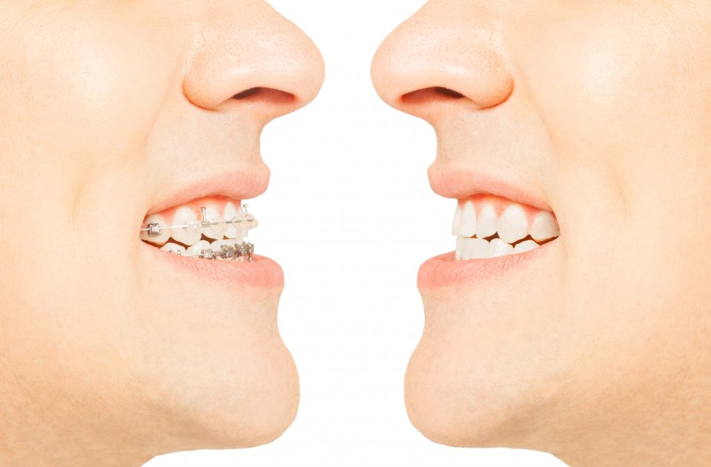 ¿Qué ventajas tiene la ortodoncia mixta?