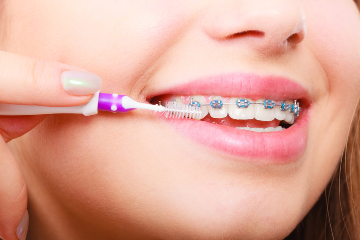¿Cómo cuidar los brackets? Consejos para un tratamiento exitoso